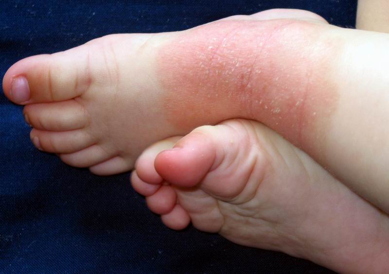 Dermatitis atopica en toblillos